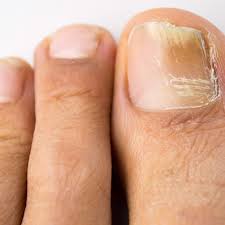 how to get rid of fingernail fungus